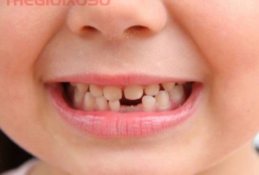 Giải Mã Ý Nghĩa Giấc Mơ Thấy Rụng Răng - Mơ Rụng Răng Là Điềm Tốt Hay Xấu?